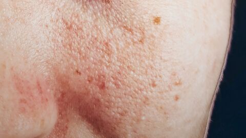 Piel con dermatitis Piel con dermatitis