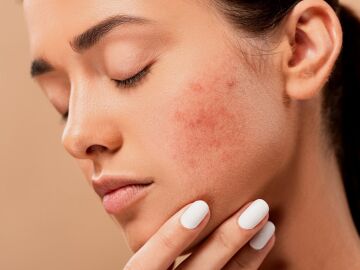 Cómo cuidar la piel si estás siguiendo un tratamiento para el acné