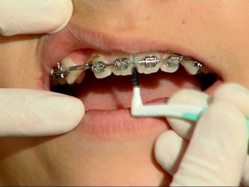 La higiene dental con braquets